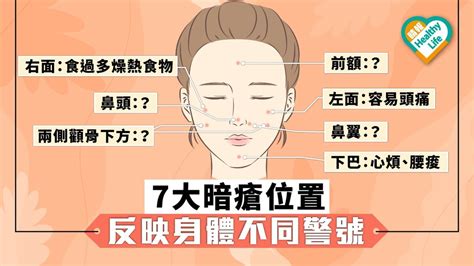 鼻邊生瘡|12個暗瘡位置揭示身體狀況｜中醫拆解人中、下巴、額 